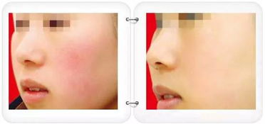 去除红血丝的小偏方