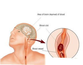 脑梗偏方有哪些