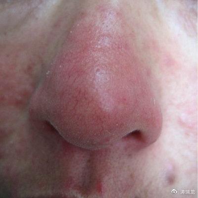 鼻子像草莓一样怎么办