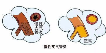 气管炎怎么治才能彻底除根偏方