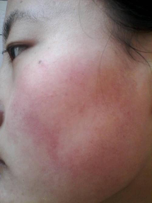 脸颊红血丝怎么能改善