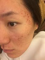 战痘后的修复之战抚平脸上的痘坑痘印全攻略